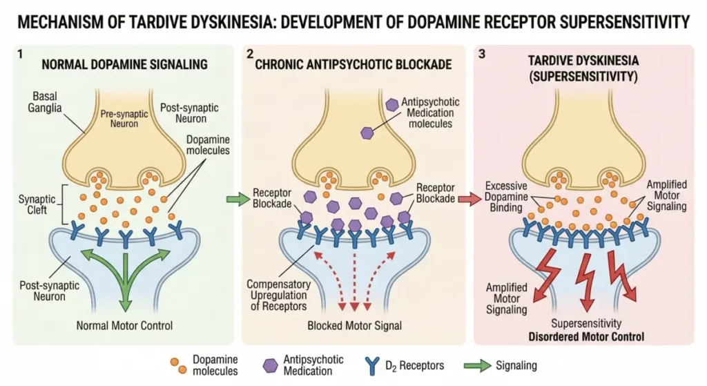 Medical diagram illustrating the development of dopamine receptor supersensitivity in Tardive Dyskinesia due to chronic antipsychotic use