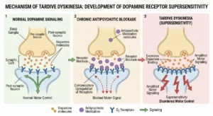 Medical diagram illustrating the development of dopamine receptor supersensitivity in Tardive Dyskinesia due to chronic antipsychotic use
